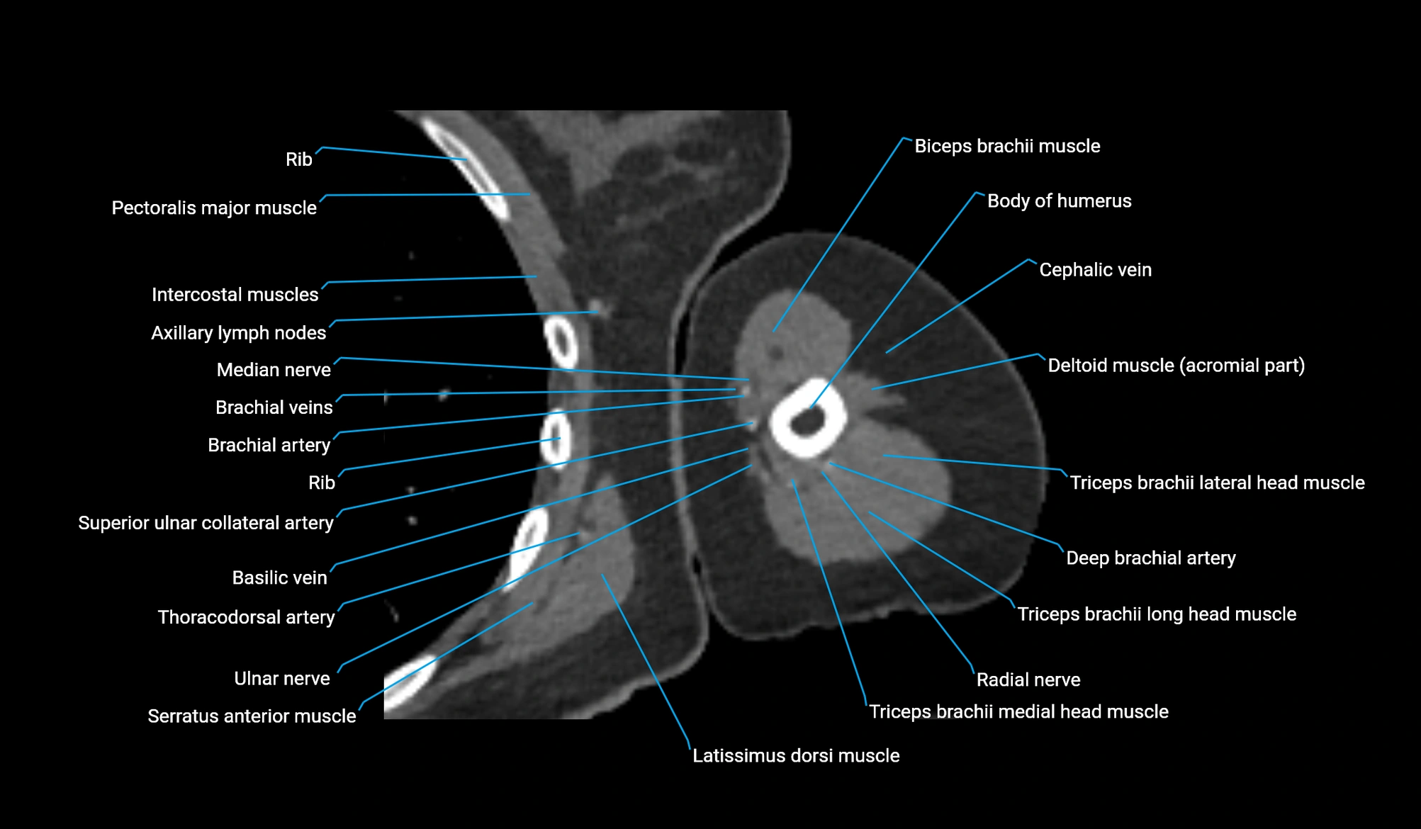 CT upper arm axial  cross sectional anatomy labelled radiology image -00218.webp